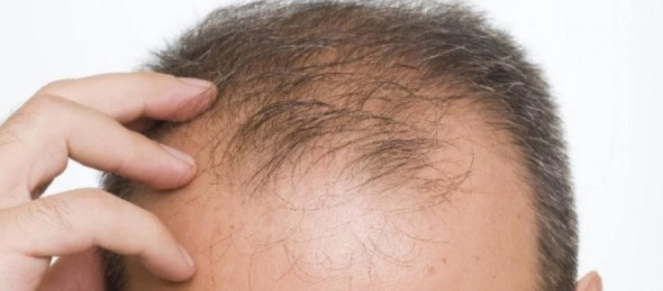 Αυτοί είναι οι τρόποι για να θεραπευτείτε από την αλωπεκία